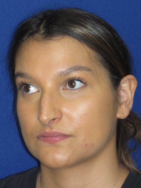 Rhinoplasty Before & After Gallery - Patient 335222 - Image 9