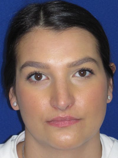 Rhinoplasty Before & After Gallery - Patient 335222 - Image 4
