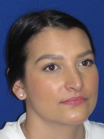 Rhinoplasty Before & After Gallery - Patient 335222 - Image 2