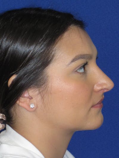 Rhinoplasty Before & After Gallery - Patient 335222 - Image 6