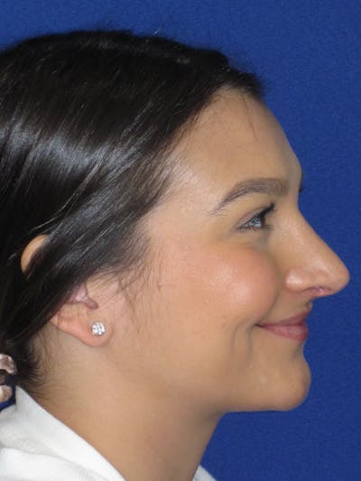 Rhinoplasty Before & After Gallery - Patient 335222 - Image 8