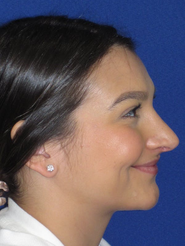 Rhinoplasty Before & After Gallery - Patient 335222 - Image 8