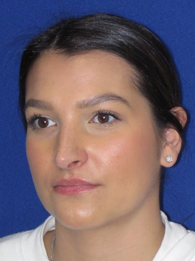 Rhinoplasty Before & After Gallery - Patient 335222 - Image 10