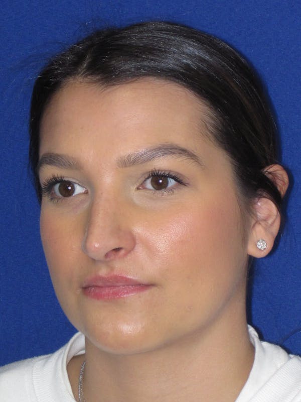 Rhinoplasty Before & After Gallery - Patient 335222 - Image 10