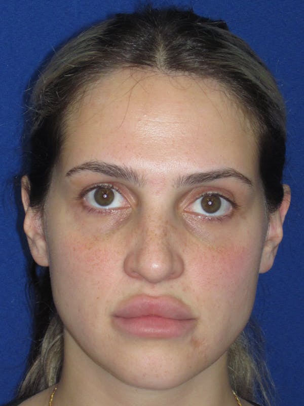 Rhinoplasty Before & After Gallery - Patient 269098 - Image 3
