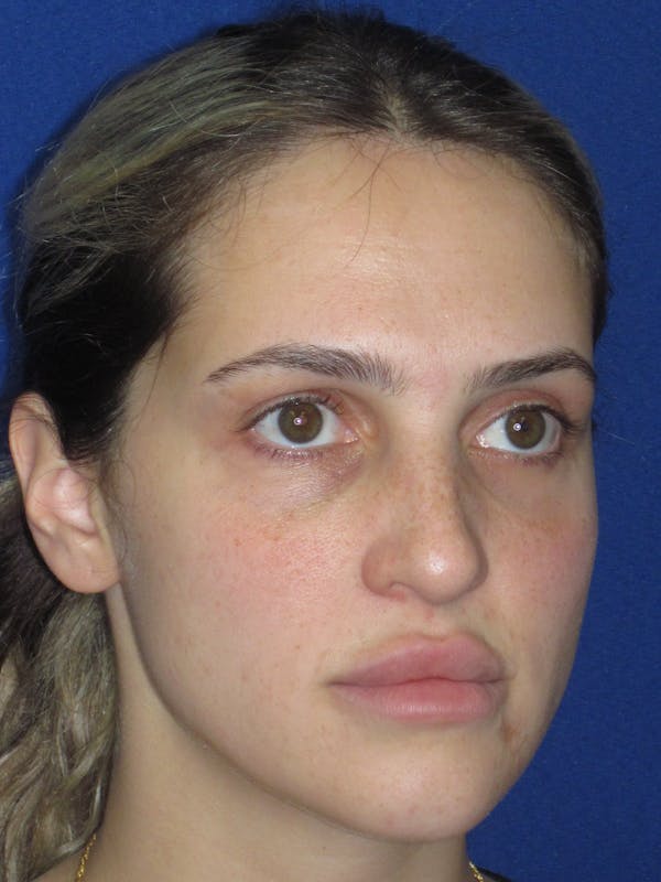 Rhinoplasty Before & After Gallery - Patient 269098 - Image 5