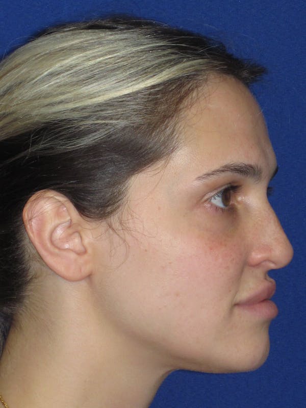 Rhinoplasty Before & After Gallery - Patient 269098 - Image 1