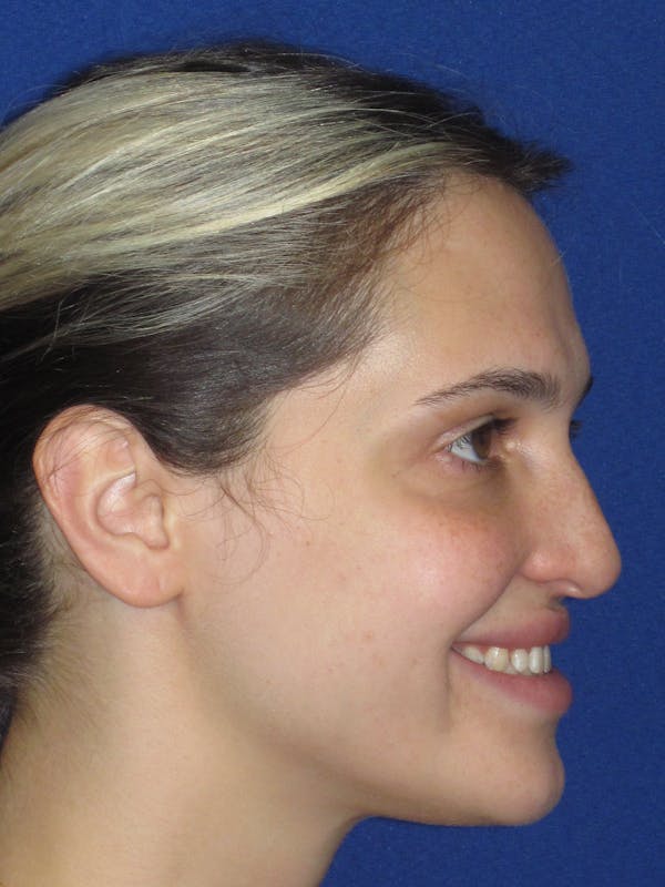 Rhinoplasty Before & After Gallery - Patient 269098 - Image 7