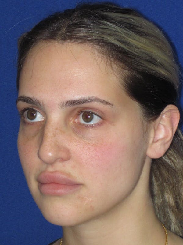 Rhinoplasty Before & After Gallery - Patient 269098 - Image 9