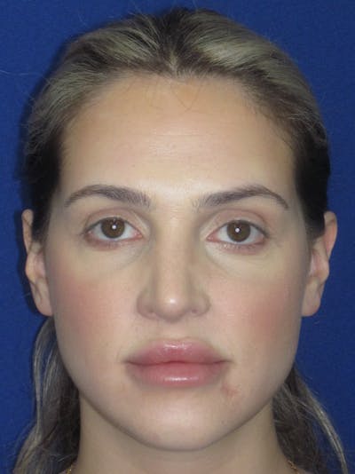 Rhinoplasty Before & After Gallery - Patient 269098 - Image 4