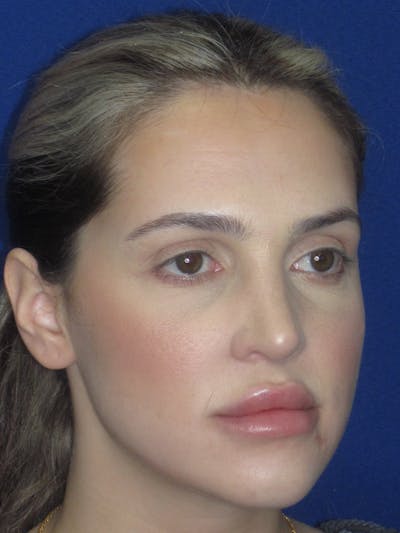 Rhinoplasty Before & After Gallery - Patient 269098 - Image 6