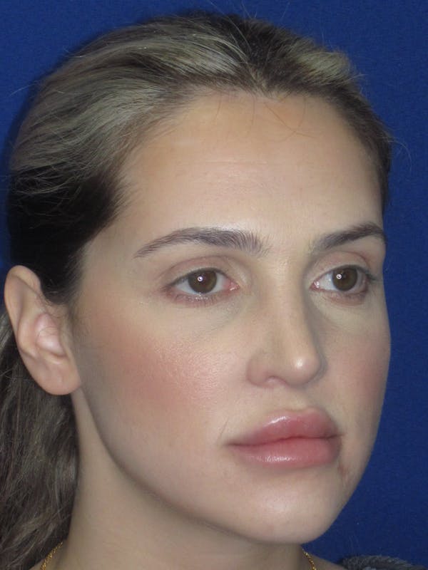 Rhinoplasty Before & After Gallery - Patient 269098 - Image 6