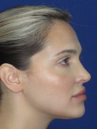 Rhinoplasty Before & After Gallery - Patient 269098 - Image 2