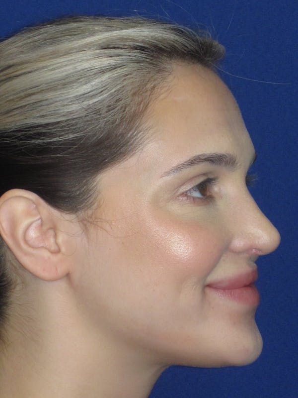 Rhinoplasty Before & After Gallery - Patient 269098 - Image 8
