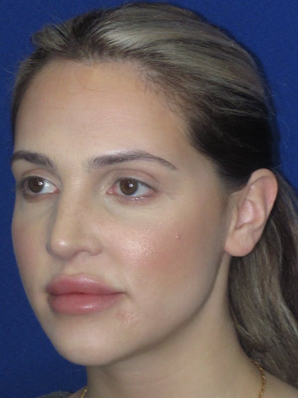 Rhinoplasty Before & After Gallery - Patient 269098 - Image 10