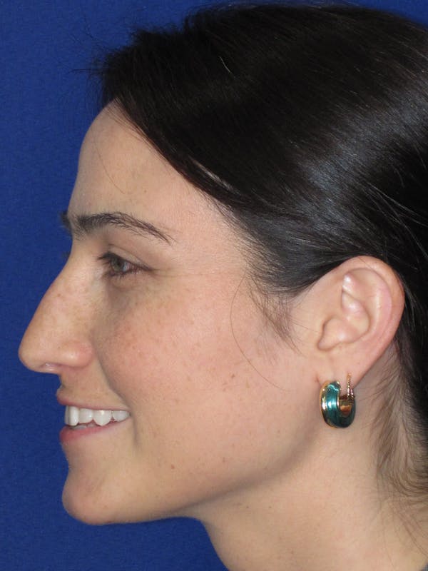 Rhinoplasty Before & After Gallery - Patient 601974 - Image 7