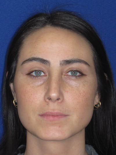 Rhinoplasty Before & After Gallery - Patient 601974 - Image 2