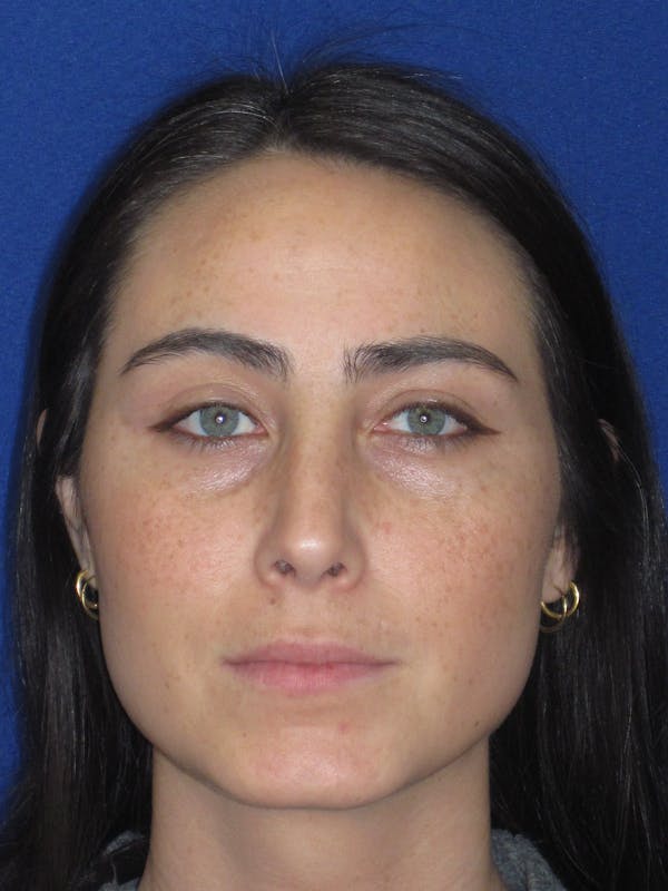 Rhinoplasty Before & After Gallery - Patient 601974 - Image 2
