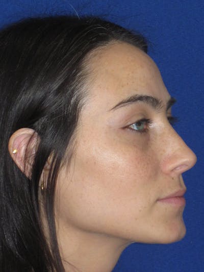 Rhinoplasty Before & After Gallery - Patient 601974 - Image 6