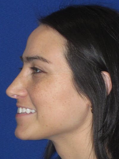 Rhinoplasty Before & After Gallery - Patient 601974 - Image 8