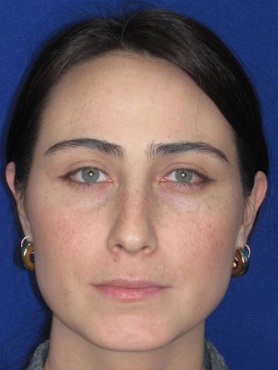 Rhinoplasty Before & After Gallery - Patient 601974 - Image 1