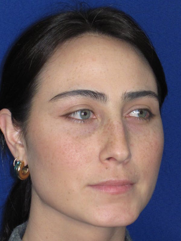 Rhinoplasty Before & After Gallery - Patient 601974 - Image 3