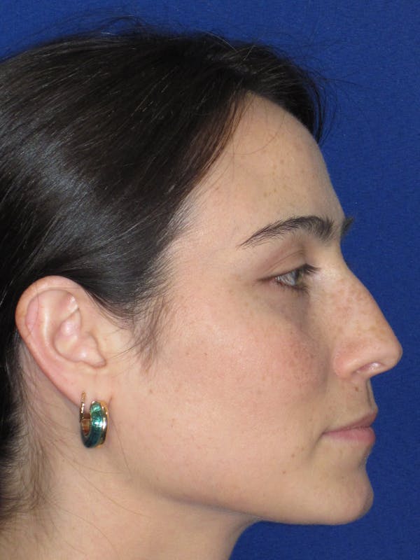 Rhinoplasty Before & After Gallery - Patient 601974 - Image 5