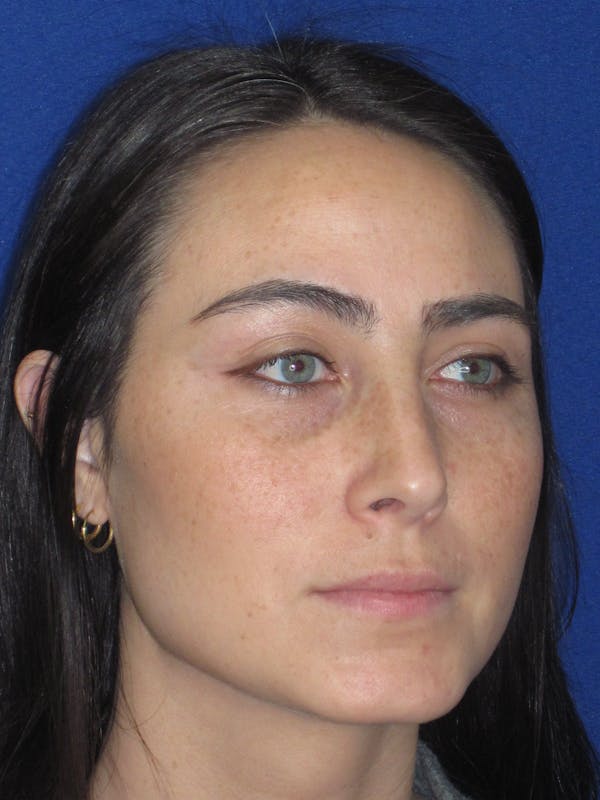 Rhinoplasty Before & After Gallery - Patient 601974 - Image 4