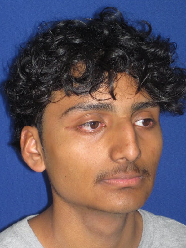Rhinoplasty Before & After Gallery - Patient 486114 - Image 7