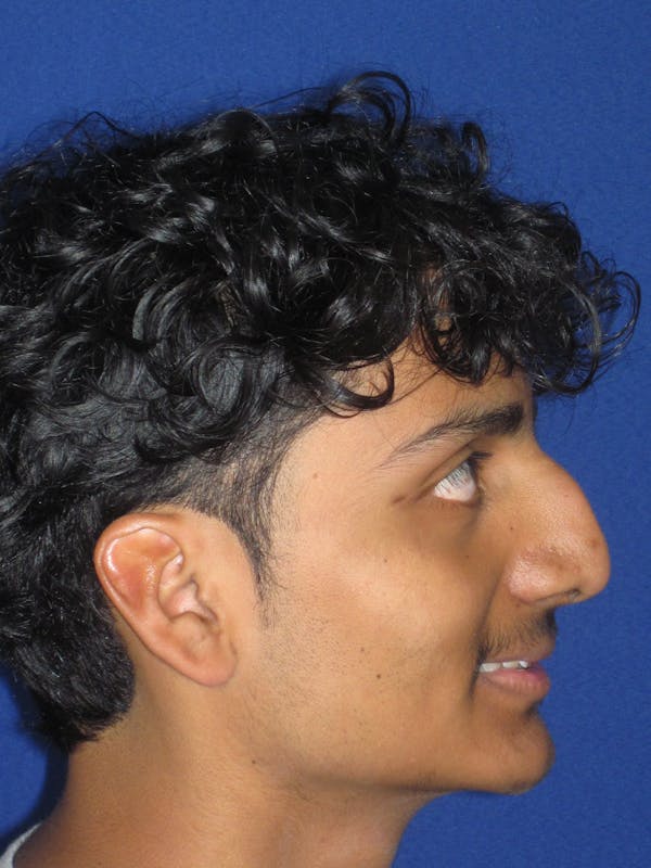 Rhinoplasty Before & After Gallery - Patient 486114 - Image 11