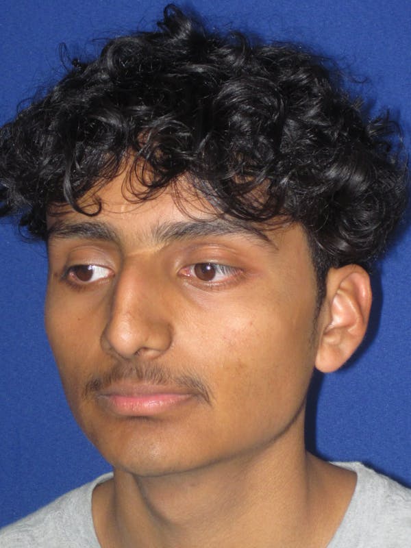 Rhinoplasty Before & After Gallery - Patient 486114 - Image 5