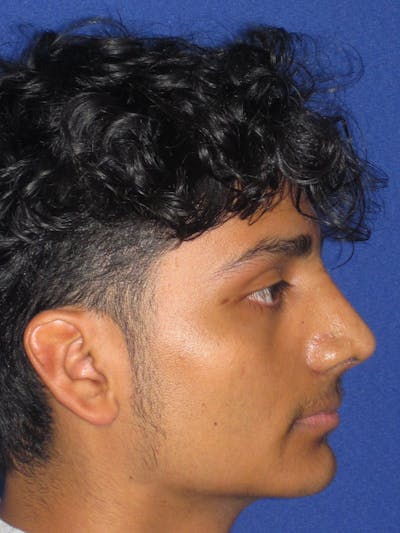 Rhinoplasty Before & After Gallery - Patient 486114 - Image 10
