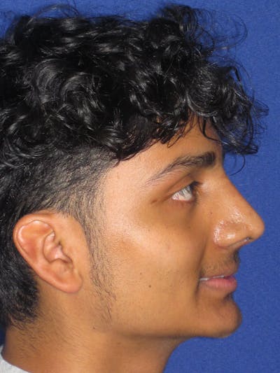 Rhinoplasty Before & After Gallery - Patient 486114 - Image 12