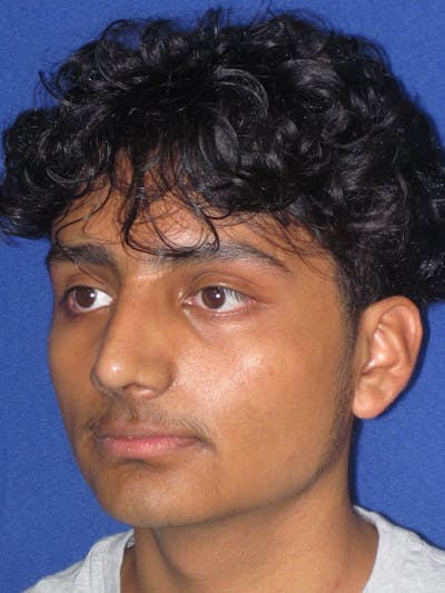 Rhinoplasty Before & After Gallery - Patient 486114 - Image 6