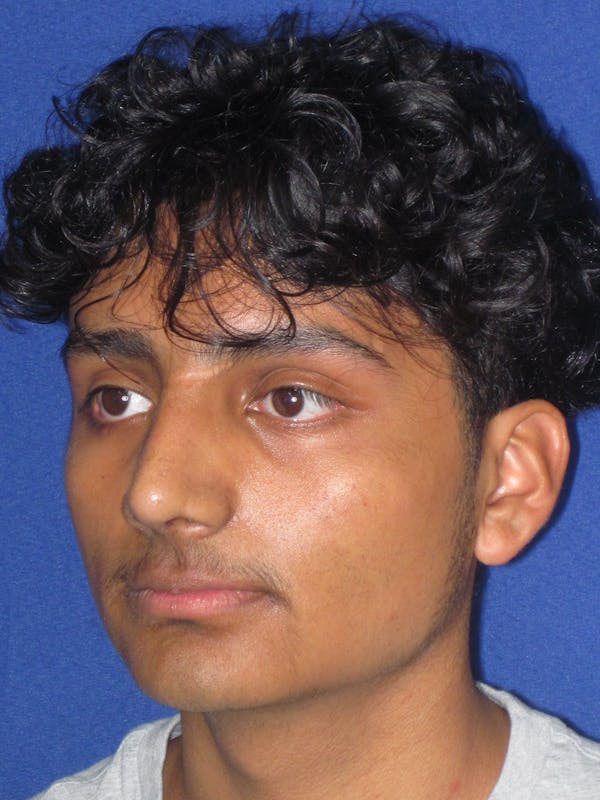 Rhinoplasty Before & After Gallery - Patient 486114 - Image 6