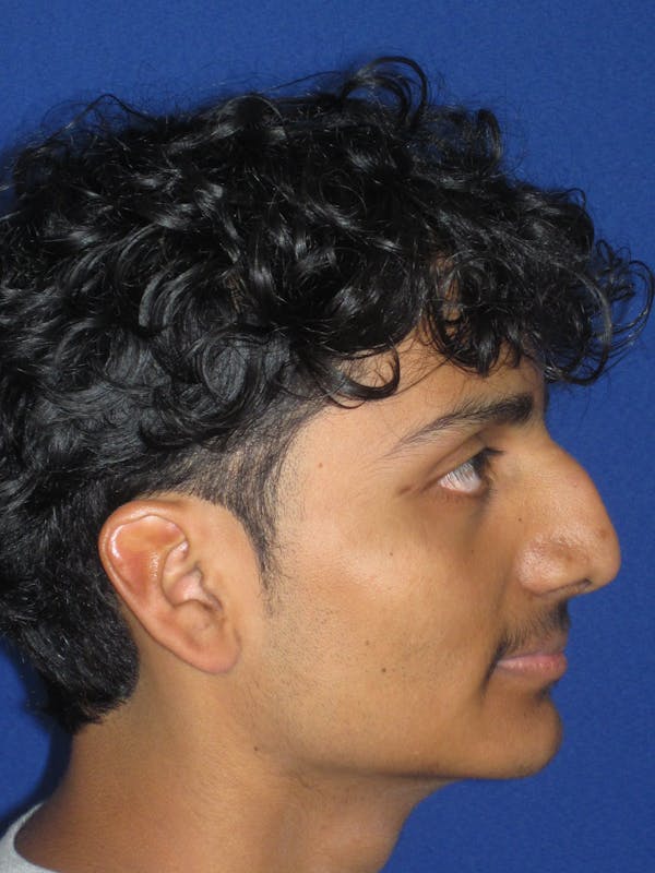 Rhinoplasty Before & After Gallery - Patient 486114 - Image 9