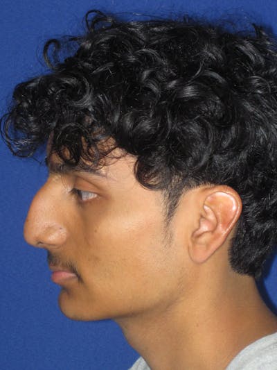 Rhinoplasty Before & After Gallery - Patient 486114 - Image 1