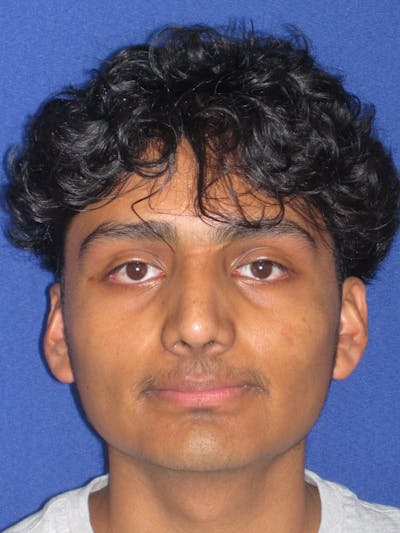 Rhinoplasty Before & After Gallery - Patient 486114 - Image 4