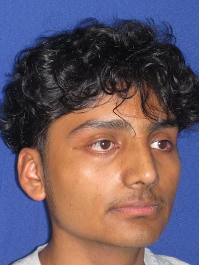 Rhinoplasty Before & After Gallery - Patient 486114 - Image 8