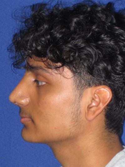 Rhinoplasty Before & After Gallery - Patient 486114 - Image 2
