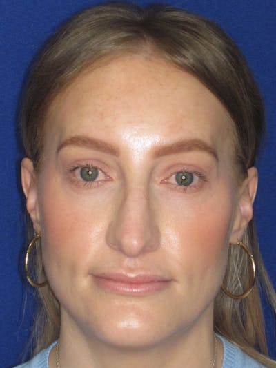 Rhinoplasty Before & After Gallery - Patient 228460 - Image 1