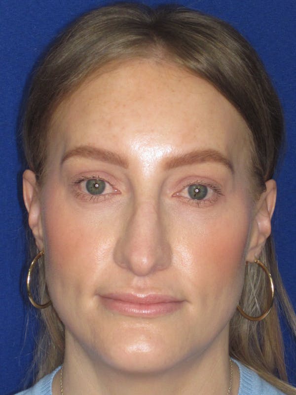 Rhinoplasty Before & After Gallery - Patient 228460 - Image 1