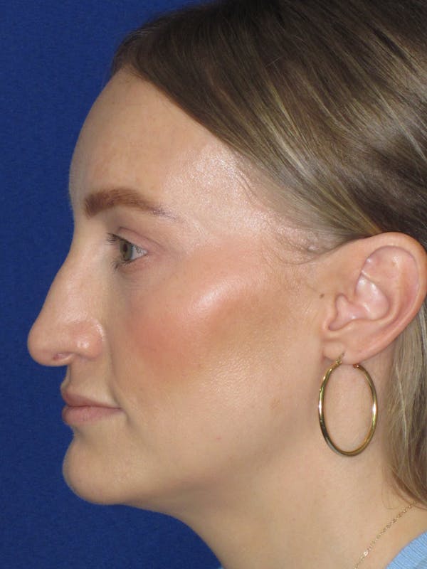 Rhinoplasty Before & After Gallery - Patient 228460 - Image 7