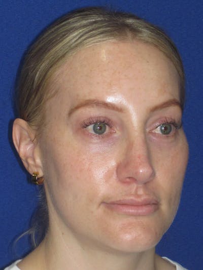 Rhinoplasty Before & After Gallery - Patient 228460 - Image 4