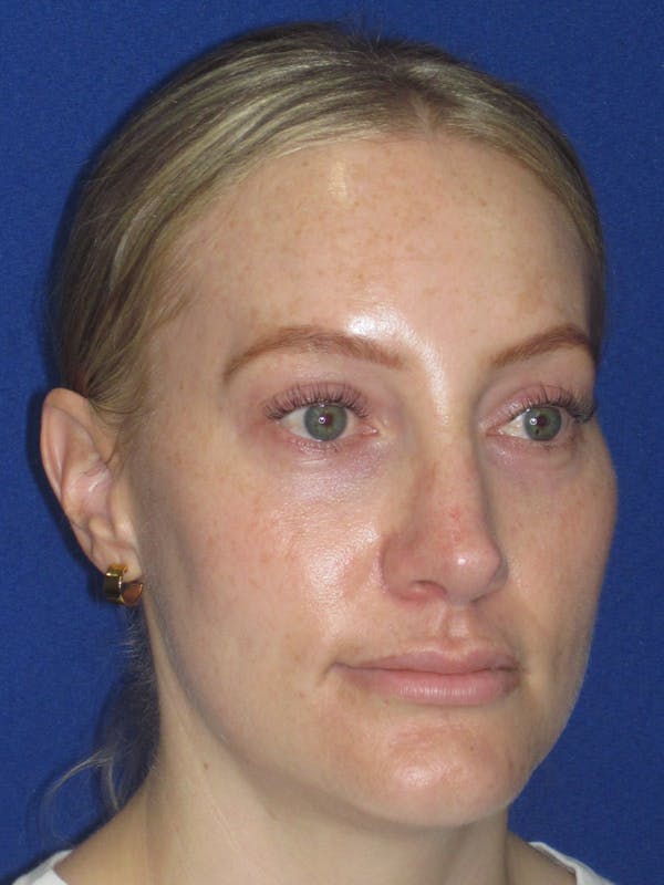 Rhinoplasty Before & After Gallery - Patient 228460 - Image 4