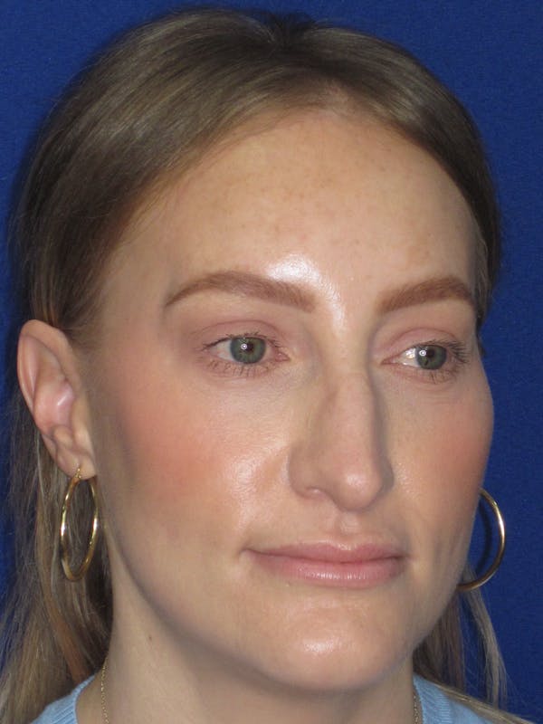 Rhinoplasty Before & After Gallery - Patient 228460 - Image 3