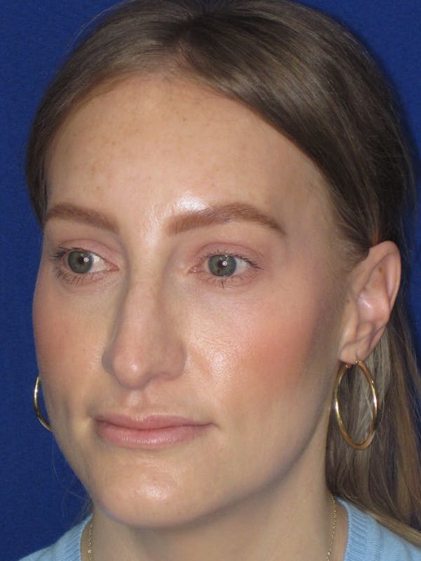 Rhinoplasty Before & After Gallery - Patient 228460 - Image 5