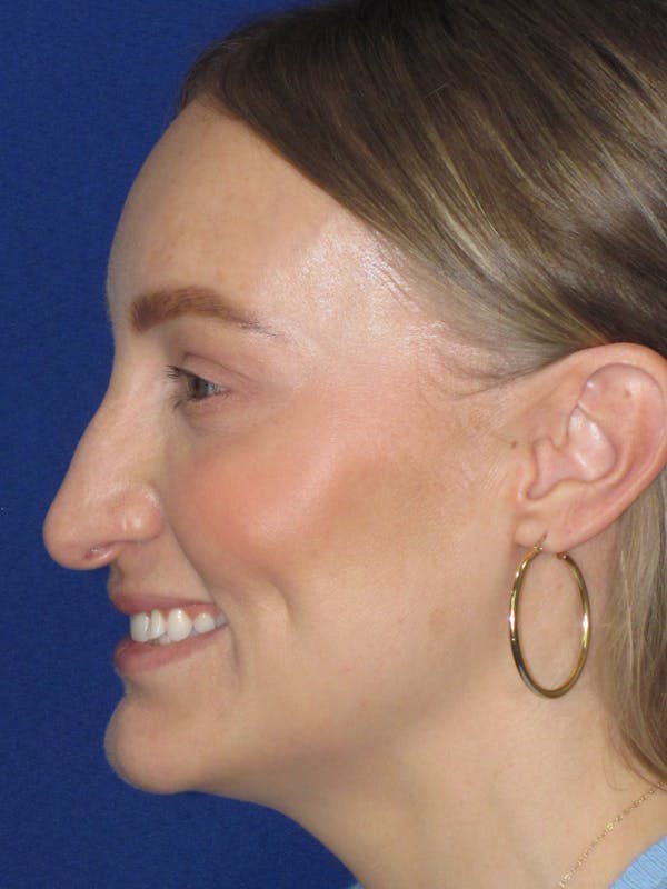 Rhinoplasty Before & After Gallery - Patient 228460 - Image 9