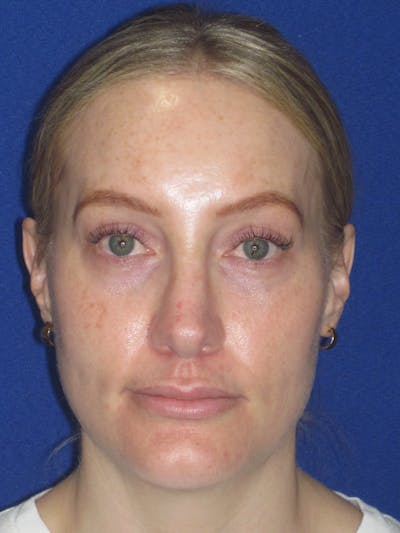 Rhinoplasty Before & After Gallery - Patient 228460 - Image 2