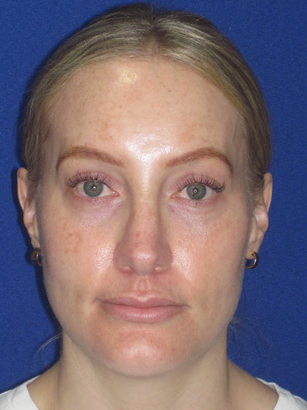 Rhinoplasty Before & After Gallery - Patient 228460 - Image 2